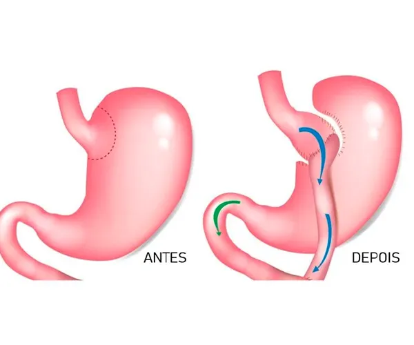 Ilustração — Bypass Gástrico