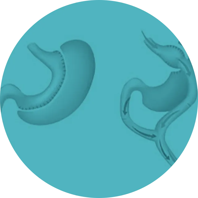Ilustração — Cirurgia Metabólica