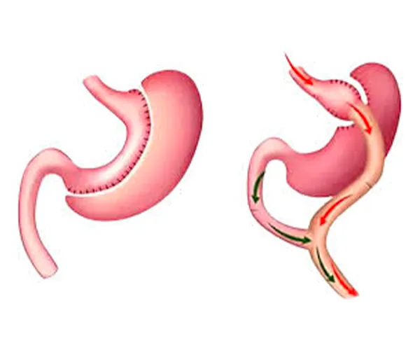 Ilustração — Cirurgia Metabólica