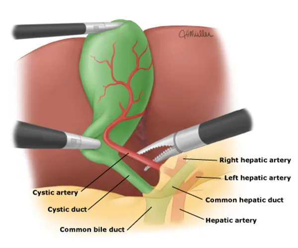 Ilustração — Cirurgia de Vesícula Aberta