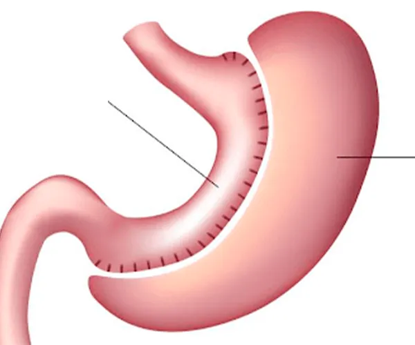 Ilustração — Sleeve Gástrico