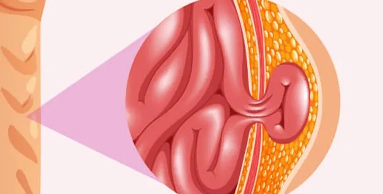 Ilustração — Cirurgia de Hérnia Epigástrica