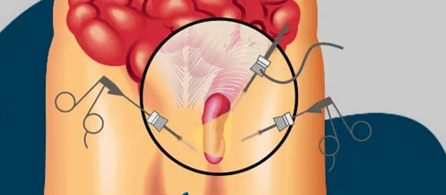 Ilustração — Cirurgia de Hérnia Inguinal