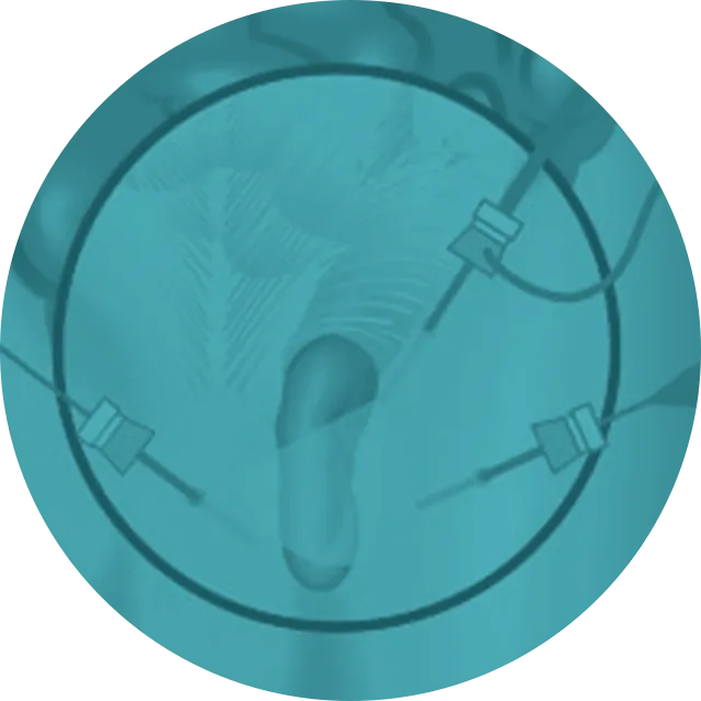 Ilustração — Cirurgia de Hérnia Inguinal