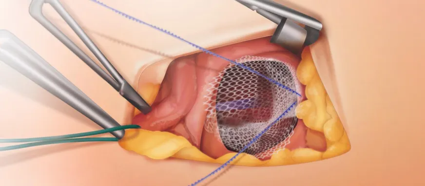 Ilustração — Cirurgia de Hérnia Recidivada