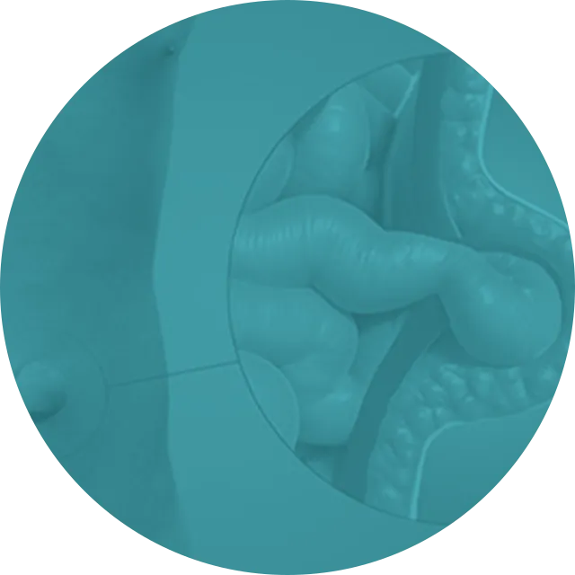Ilustração — Cirurgia de Hérnia Umbilical