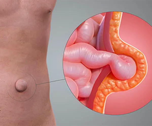 Ilustração — Cirurgia de Hérnia Umbilical